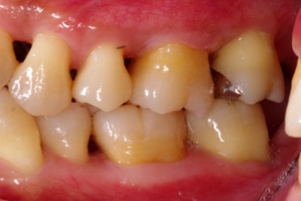 歯周病治療の症例