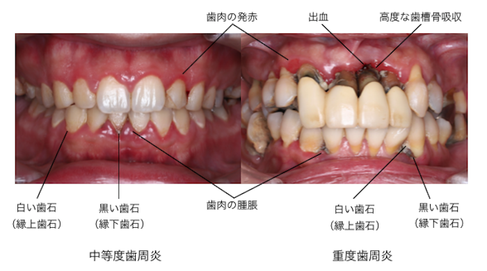 中等度歯周炎と重度歯周炎の違い