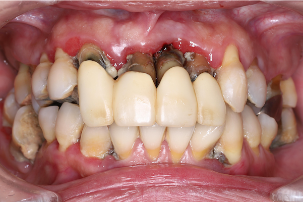 正面から見た重度歯周病