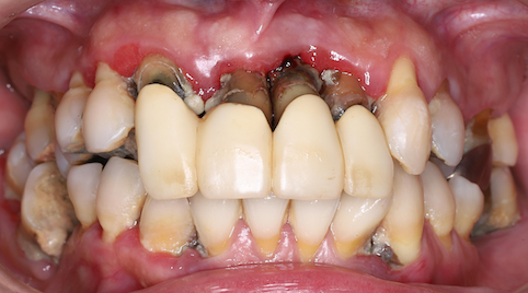 歯周病の治療方法
